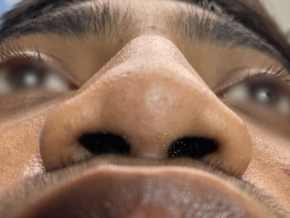 Before - Wide Nostril